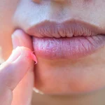 Liệu trị thâm môi bằng vitamin C có thực sự hiệu quả?